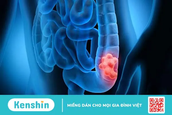 U trực tràng ác tính và những điều cần biết 4