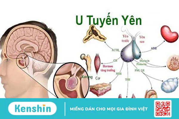 U tuyến yên tăng tiết prolactin là gì và cách điều trị hiệu quả 1