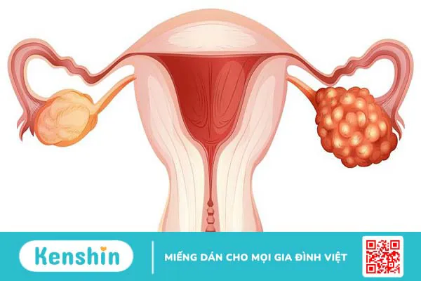 Ung thư buồng trứng giai đoạn 2: Tỷ lệ sống và hướng điều trị tốt nhất