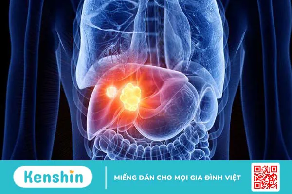 Ung thư gan giai đoạn 2: Những thông tin quan trọng