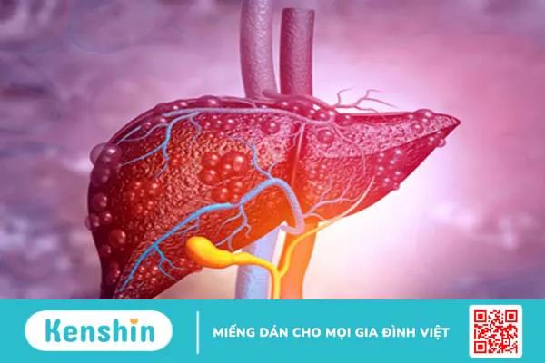 Những thông tin quan trọng về ung thư gan giai đoạn 2 3