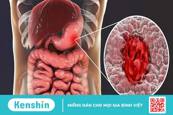 Ung thư giai đoạn 3 có chữa được không?