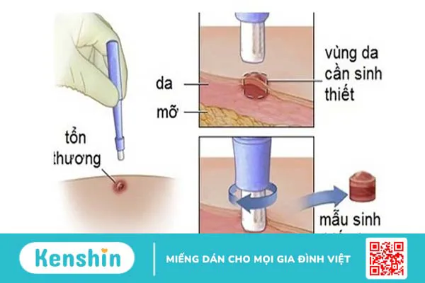 Ung thư hắc tố da là gì? Sinh thiết nốt ruồi và phân biệt nốt ruồi ác tính 2