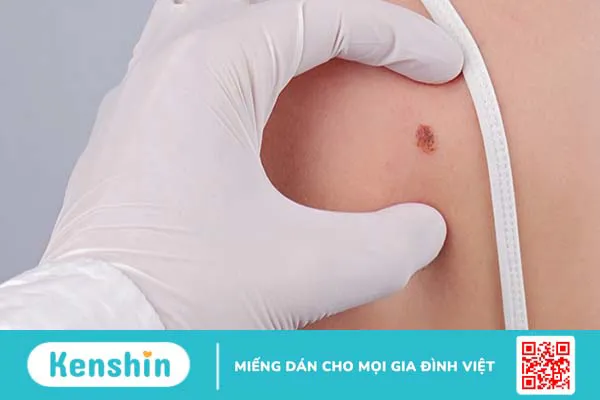 Ung thư hắc tố da là gì? Sinh thiết nốt ruồi và phân biệt nốt ruồi ác tính 3