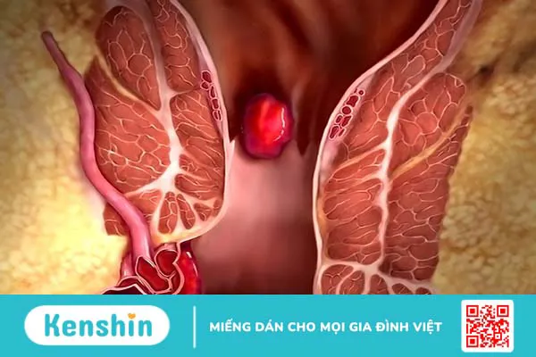 Ung thư hậu môn sống được bao lâu? Làm gì để kéo dài sự sống?