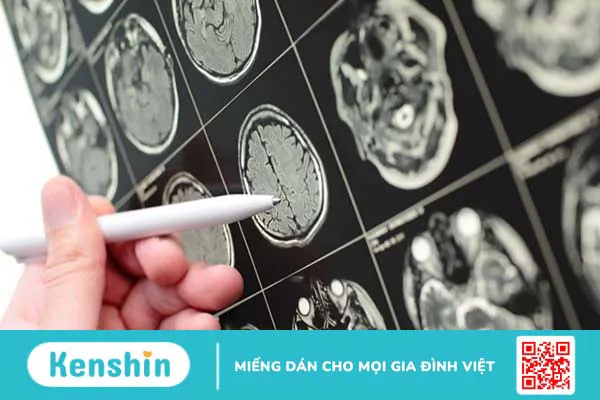 Ung thư não có chữa được không? Những yếu tố nào ảnh hưởng đến hiệu quả điều trị?