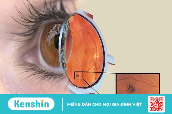 Ung thư võng mạc là gì? Nguyên nhân, biểu hiện và cách điều trị