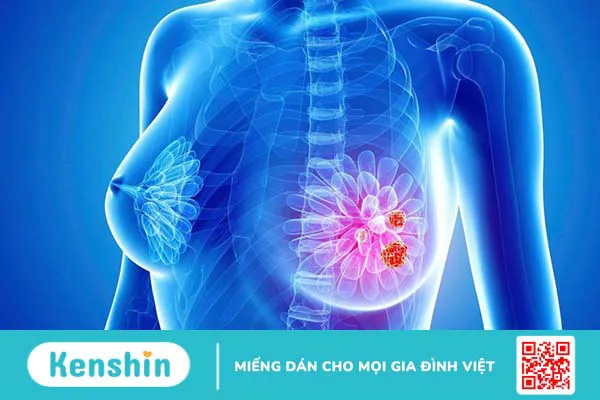 Ung thư vú bộ ba âm tính và những thông tin cần biết 1