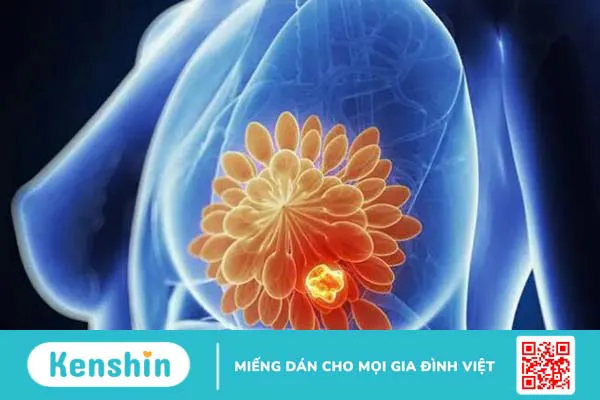 Ung thư vú thụ thể nội tiết dương tính và những điều cần biết