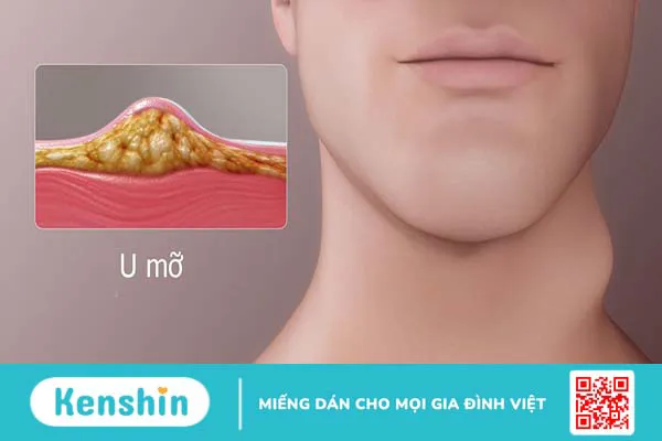 Uống gì để tiêu u mỡ? Một số nước uống giảm u mỡ hiệu quả