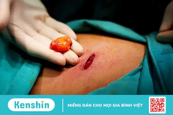 Uống gì để tiêu u mỡ? Một số nước uống giảm u mỡ hiệu quả