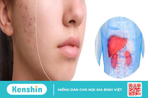 Uống thải độc gan có hết mụn không?