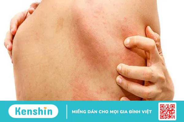 Uống thuốc dị ứng bao lâu thì có tác dụng?