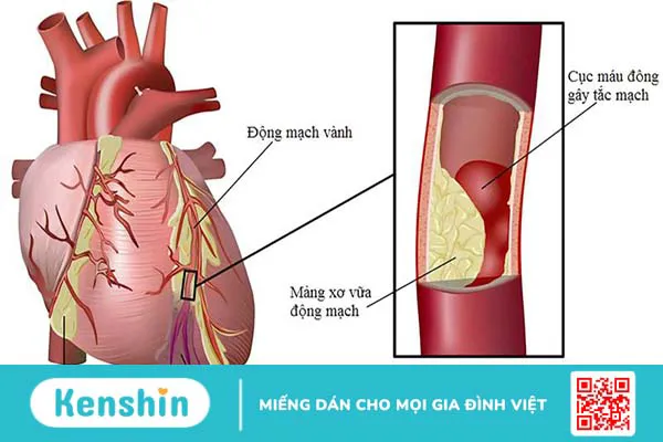 Ưu và nhược điểm của hai phương pháp stent và phẫu thuật bắc cầu