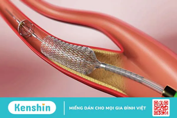 Ưu và nhược điểm của hai phương pháp stent và phẫu thuật bắc cầu