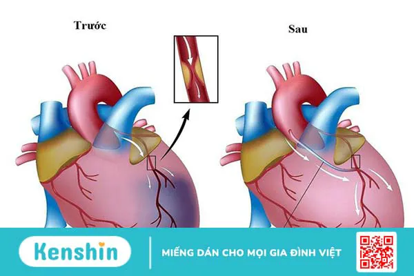 Ưu và nhược điểm của hai phương pháp stent và phẫu thuật bắc cầu