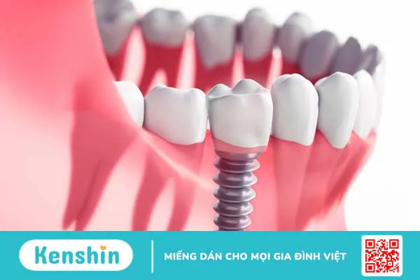 Ưu và nhược điểm khi thực hiện cấy ghép implant tức thì