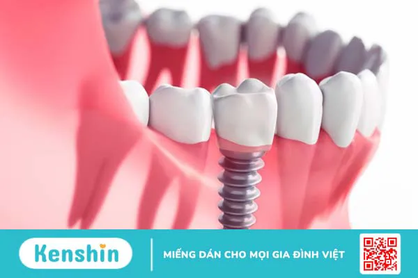 Ưu và nhược điểm khi thực hiện cấy ghép implant tức thì