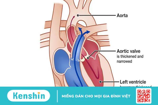 Van động mạch chủ: Cấu trúc, chức năng và bệnh lý thường gặp