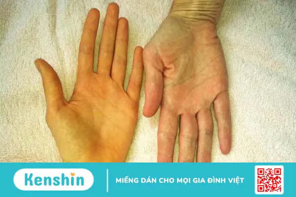 Vàng da lòng bàn tay có phải mắc bệnh không?