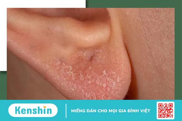 Vành tai có vảy trắng: Nguyên nhân phát sinh và cách khắc phục