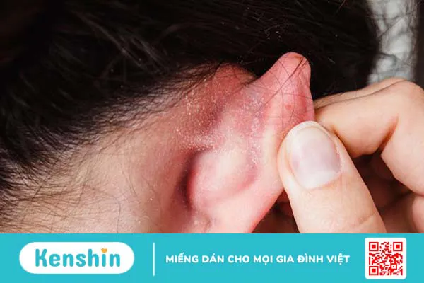 Vành tai có vảy trắng: Nguyên nhân phát sinh và cách khắc phục 3