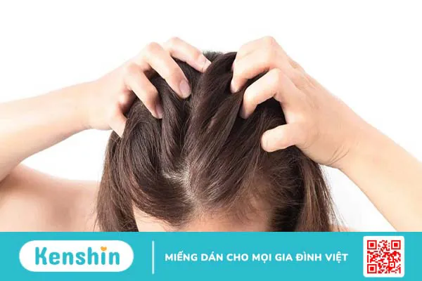 Vảy nến da đầu là gì? Bệnh vảy nến da đầu có chữa được không?