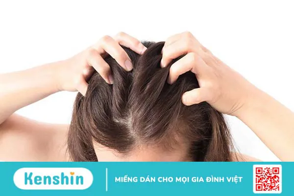 Vảy nến da đầu là gì? Bệnh vảy nến da đầu có chữa được không?