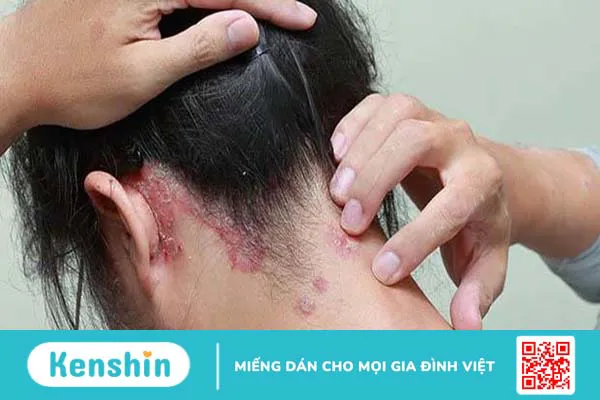 Vảy nến da đầu là gì? Nguyên nhân gây vảy nến da đầu ở trẻ em