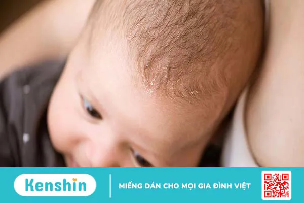 Vảy nến da đầu là gì? Nguyên nhân gây vảy nến da đầu ở trẻ em