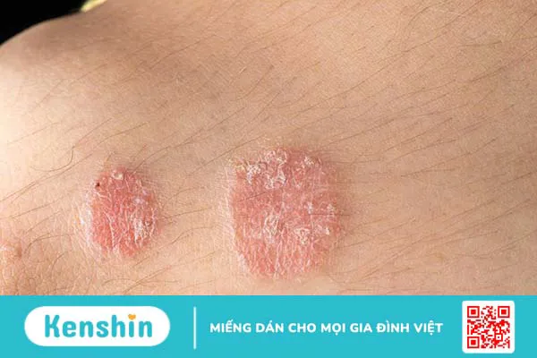 Vảy nến đồng tiền: Nguyên nhân và cách điều trị hiệu quả