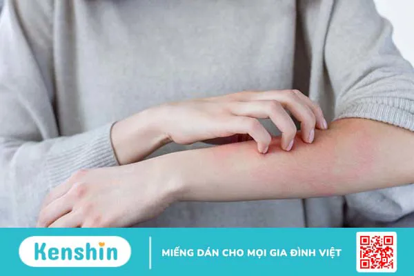 Vảy nến đồng tiền: Nguyên nhân và cách điều trị hiệu quả