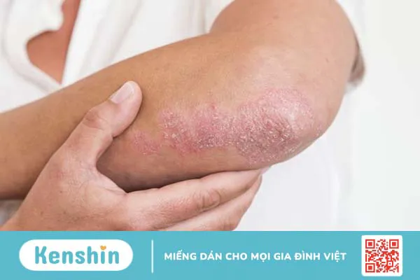 Vảy nến đồng tiền: Nguyên nhân và cách điều trị hiệu quả