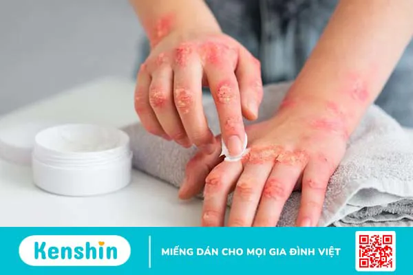 Vảy nến đồng tiền: Nguyên nhân và cách điều trị hiệu quả