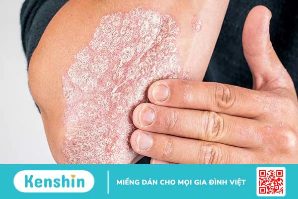 Vảy nến giai đoạn đầu có triệu chứng gì? Cách điều trị như thế nào?