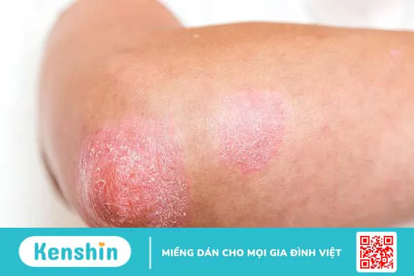 Vảy nến giai đoạn đầu có triệu chứng gì? Cách điều trị như thế nào?