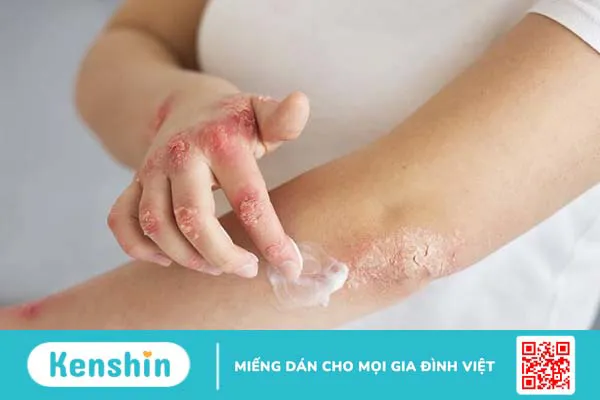 Vảy nến giai đoạn đầu có triệu chứng gì? Cách điều trị như thế nào?