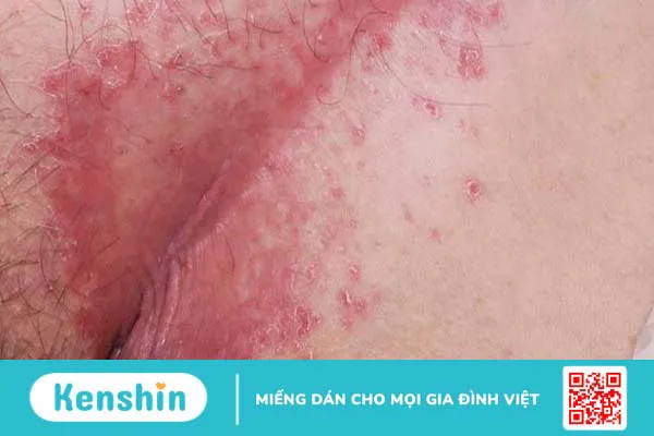 Vảy nến ở dương vật có thể trị khỏi không?