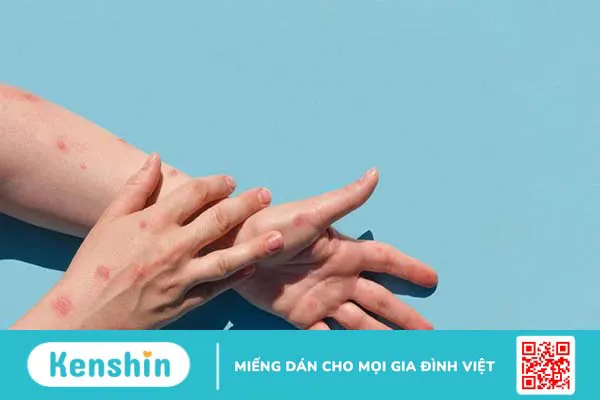 Vảy phấn hồng Gibert là gì? Các biện pháp chữa bệnh vảy phấn hồng Gibert