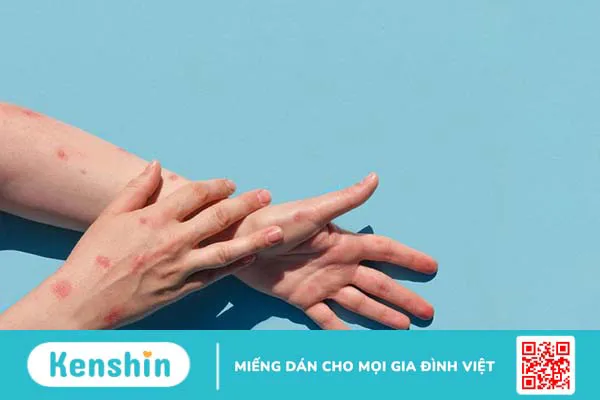 Vảy phấn hồng Gibert là gì? Các biện pháp chữa bệnh vảy phấn hồng Gibert? 1