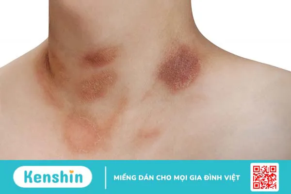 Vảy phấn hồng Gibert là gì? Các biện pháp chữa bệnh vảy phấn hồng Gibert? 2