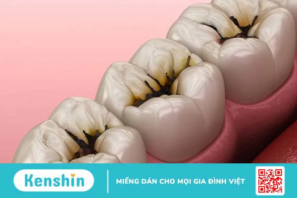 Vết đen trên răng hàm là do những nguyên nhân gì?