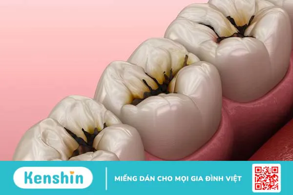 Vết đen trên răng hàm là do những nguyên nhân gì? 1