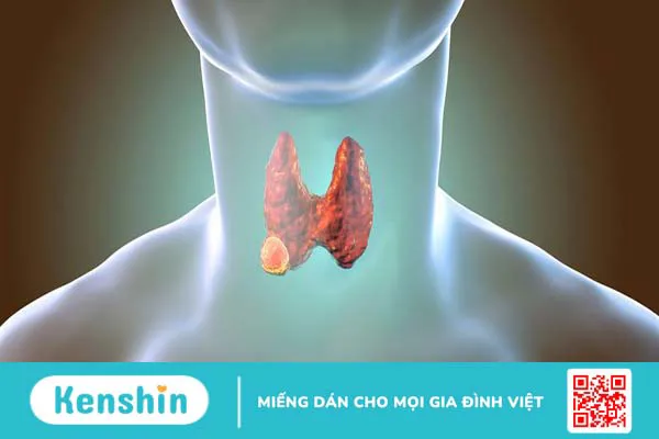 Vết mổ bướu cổ bao lâu mới lành? Chăm sóc người bệnh sau mổ bướu cổ