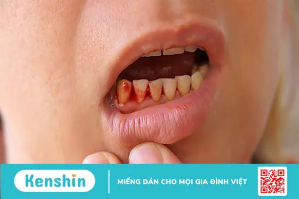 Vị giác có mùi máu nguyên nhân do đâu?