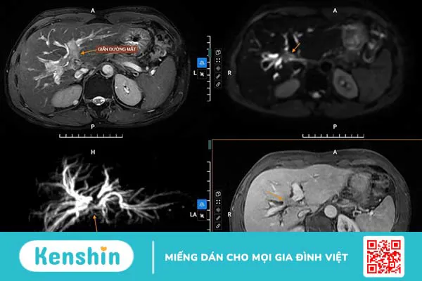 Vì sao cần dẫn lưu đường mật? Các bước cần chuẩn bị và quy trình thực hiện thủ thuật 2