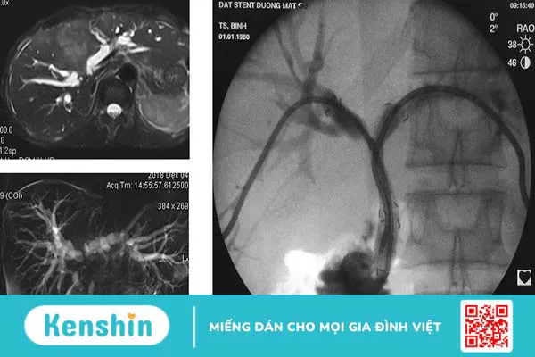 Vì sao cần dẫn lưu đường mật? Các bước cần chuẩn bị và quy trình thực hiện thủ thuật 3