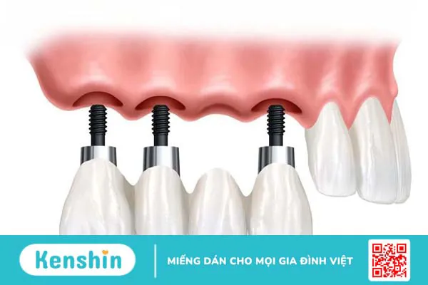 Vì sao cần nâng xoang kín trong cấy ghép implant?