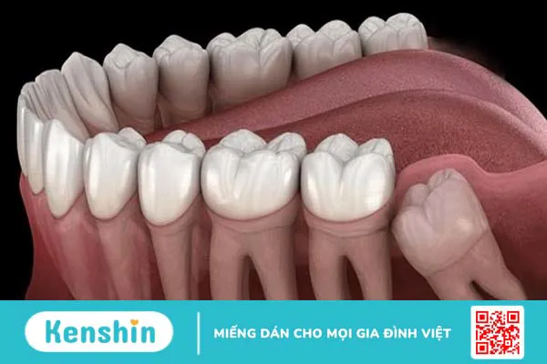 Vì sao nhổ răng khôn 3 ngày vẫn đau? Cách khắc phục là gì?