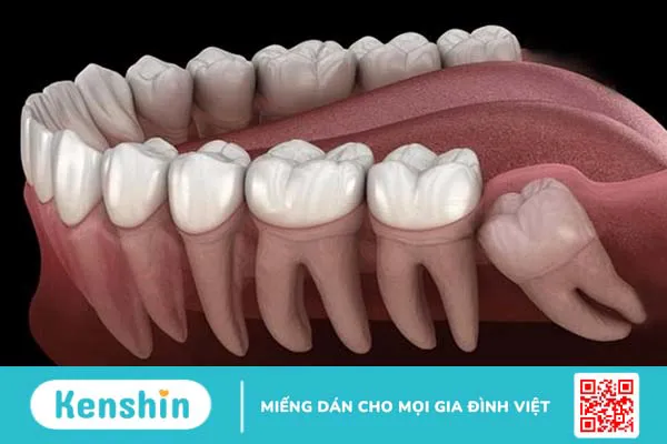 Vì sao nhổ răng khôn 3 ngày vẫn đau? Cách khắc phục là gì?